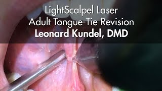 LightScalpel Laser Tongue-Tie Release - Leonard Kundel, DMD