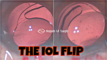 Flipping The IOL inside the eye in the "Anti-S" Position (For Aspheric IOLs) .