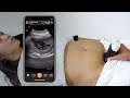 First trimester intrauterine pregnancy ultrasound scanning technique