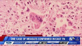 One case of measles confirmed in East Tennessee