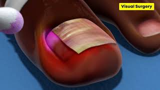 Toenail Removal Surgery| Paronychiaparonychie| Ingrown Toenail|Onychocryptosis