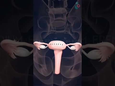 Laparoscopic Myomectomy Surgery ↪ 3D Medical Animation #LaparoscopicMyomectomy #Surgery