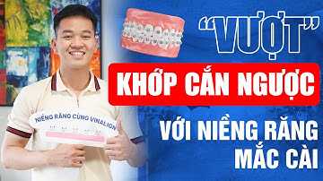 Niềng Răng Mắc Cài "Vượt" Khớp Cắn Ngược - Thay Đổi Cuộc Sống | Nam Bùi Vinalign