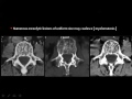 Imaging of Spine tumor   Dr Mamdouh Mahfouz In Arabic