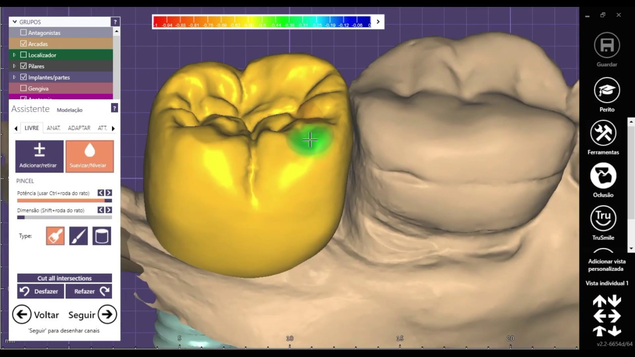 Coroa Sobre Implante (ExoCad) - Parte 1