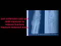 fracture supracondylar humerous treated conservative