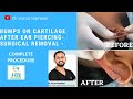 Bumps on Cartilage after Ear Piercing- Surgical Removal -Dr varun Nambiar facial Aesthetic Surgeon