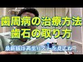 歯周病 歯石取り、除去する治療方法　説明動画４６　歯医者口臭PMTC クリーニング 大宮駅西口上小町三橋大成町宮原町鈴木歯科医院デンタル歯科クリニック