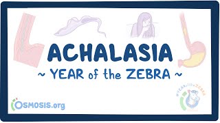 Achalasia (Year of the Zebra)