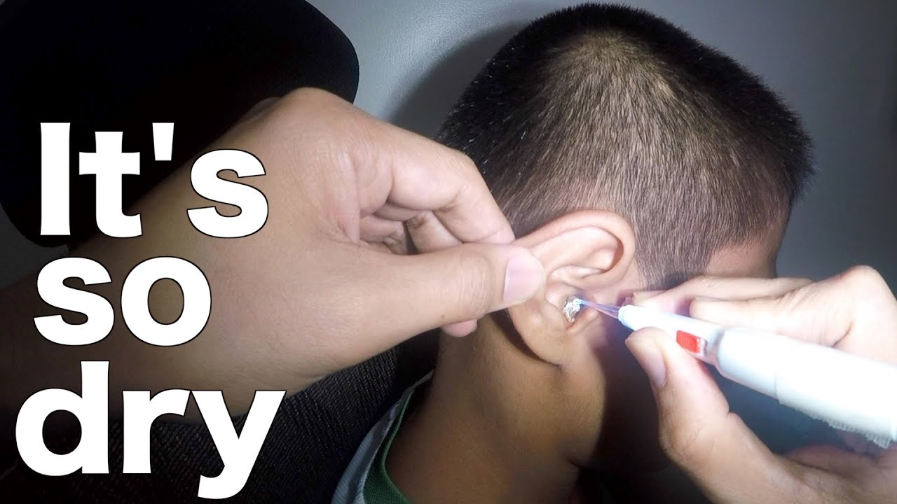 Removing Boy's Dried Up Earwax Using Lighted Ear Curette YouTube