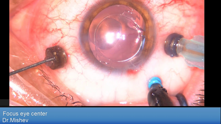 Retinal detachment repair Lukan Mishev Live Stream - 天天要聞