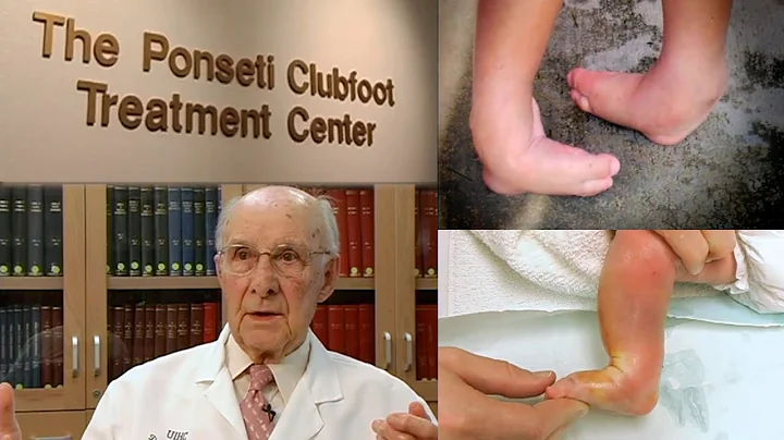A Walking Miracle - The Ponseti Method for Clubfoo...