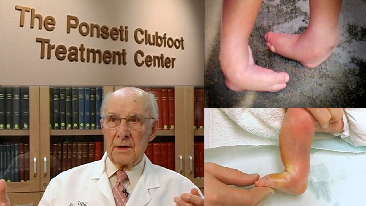 Two very different clubfoot treatments - Boston Children's Answers