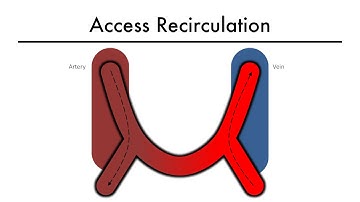 Hemodialysis Kinetics 101 08 Access Recirculation