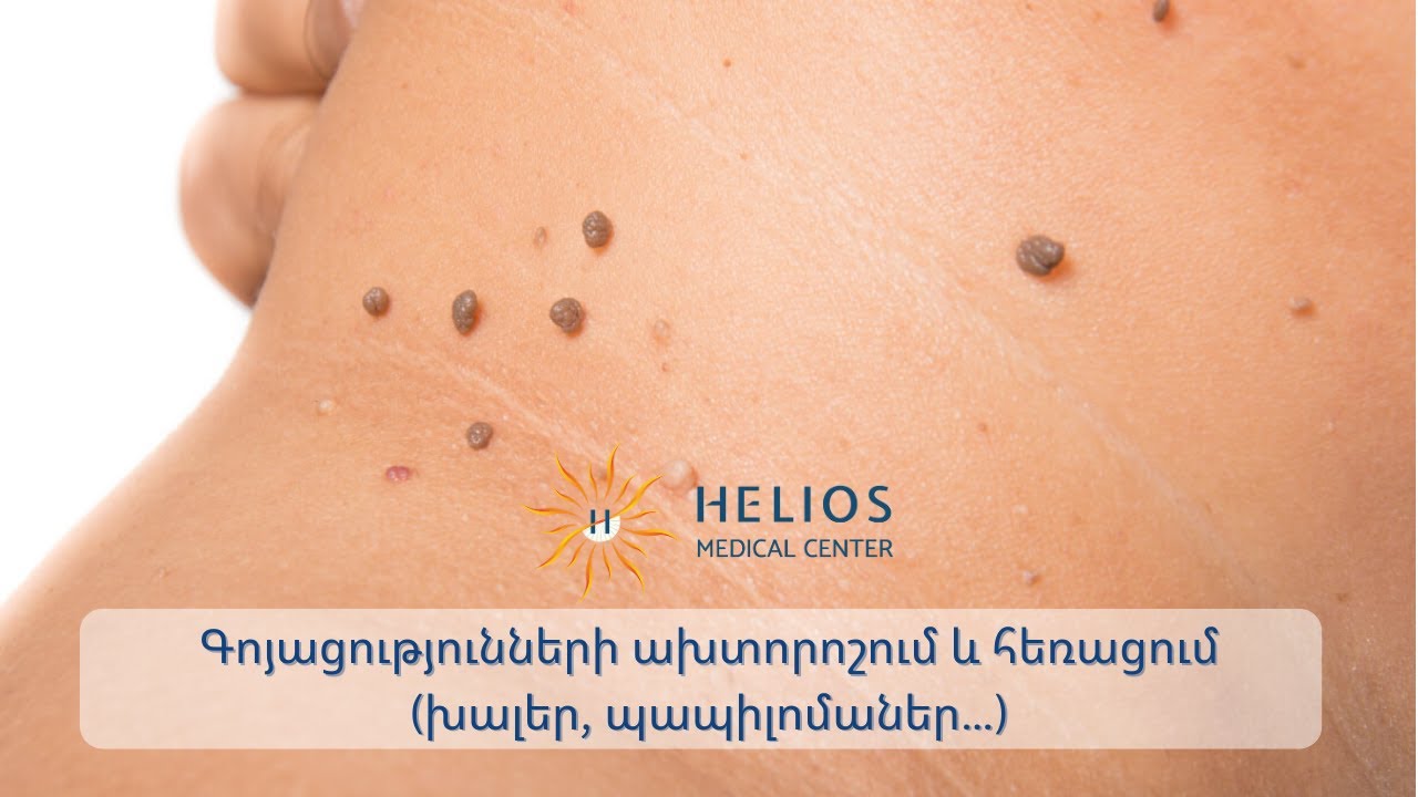 🤔Ի՞նչ անել, եթե մաշկին նկատել եք գոյացություններ,ինչպե՞ս կանխել դրանց հետագա բարդացումը