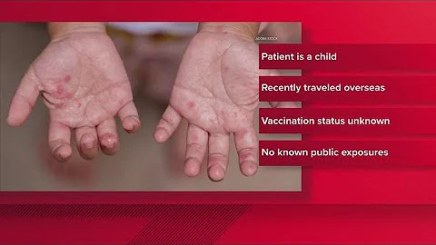 Another North Texas county reports second measles case this year, officials say