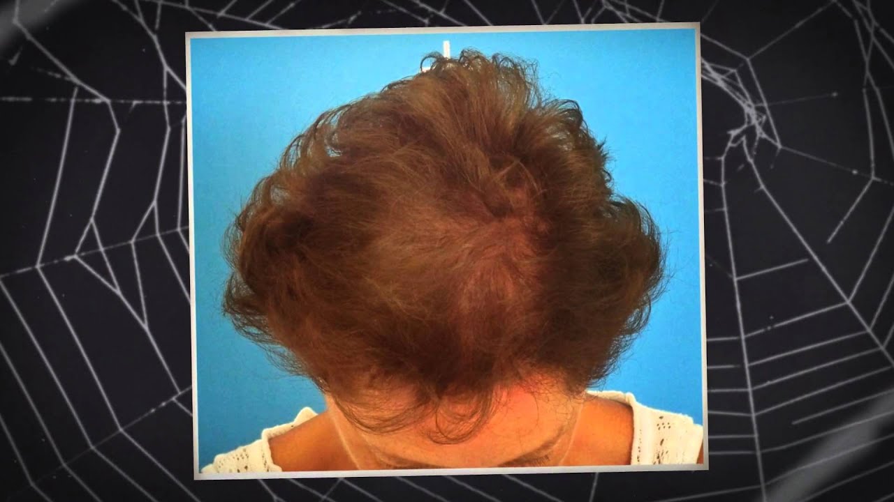 Implante Capilar en Mujeres - YouTube