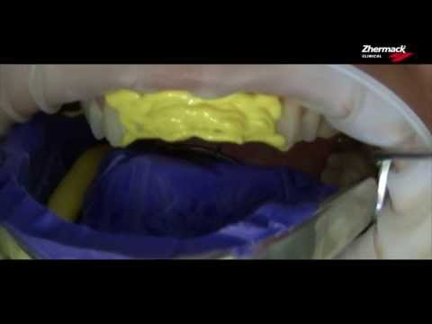 Відбитий матеріал А силікон підвищеної точності platinum 95, відео 1