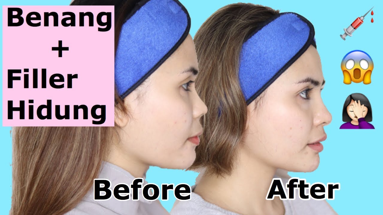 HIDUNG BARU AKU | Filler, benang dan botox - YouTube HIDUNG BARU AKU | Filler, benang dan botox - YouTube