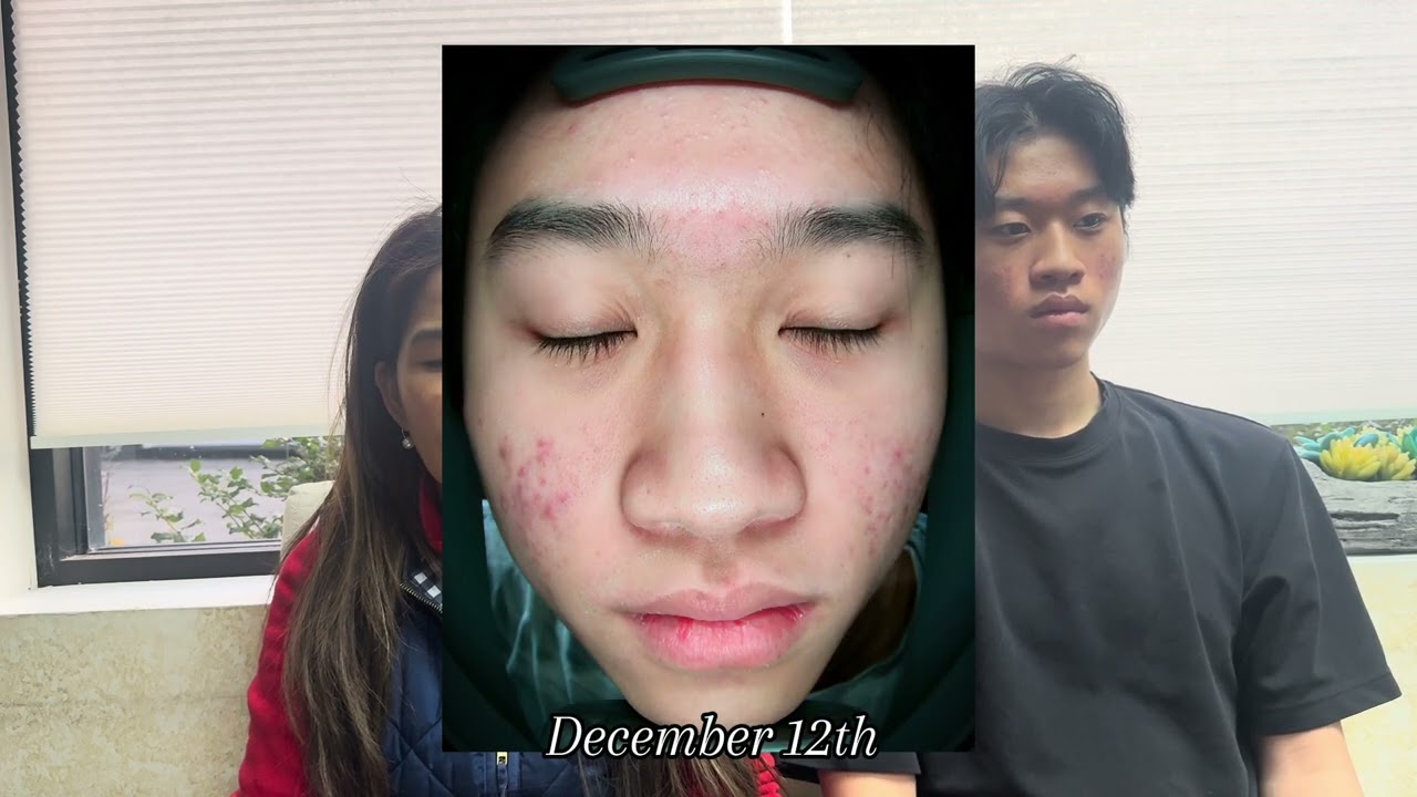 Tammy Hang treating Acne in TSG2025 - Video 8