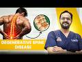 Degenerative Spine Disease: Why Your Back and Neck Pain Happens