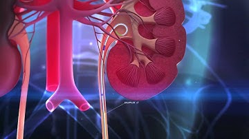 Implante de Cateter Duplo J