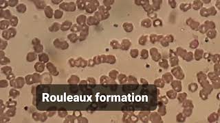 Peripheral blood smear shows rouleaux formation or aggregation of red blood cells.