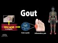 Gout, Pathophysiology, Causes, Symptoms, Risk Factors, Diagnosis and Treatments, Animation.