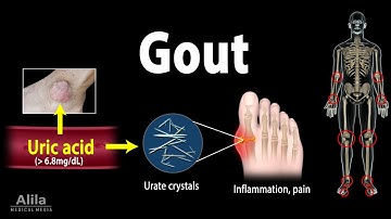 Gout, Pathophysiology, Causes, Symptoms, Risk Factors, Diagnosis and Treatments, Animation.