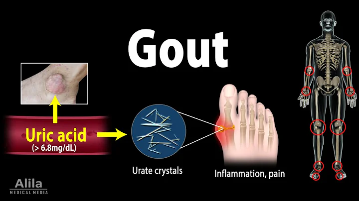 Gout, Pathophysiology, Causes, Symptoms, Risk Factors, Diagnosis and Treatments, Animation. - DayDayNews