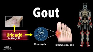 Gout, Pathophysiology, Causes, Symptoms, Risk Factors, Diagnosis and Treatments, Animation.