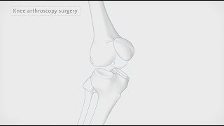 How a knee arthroscopy is performed | Spire Healthcare