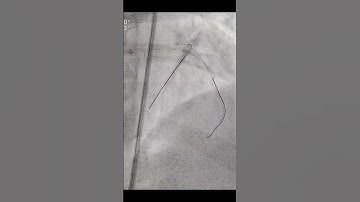 Looping of Guidewire in IVUS catheter.Kindly comment cause of looping.
