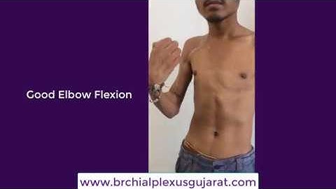 Latissimus Dorsi for Elbow Flexion in brachial plexus injury