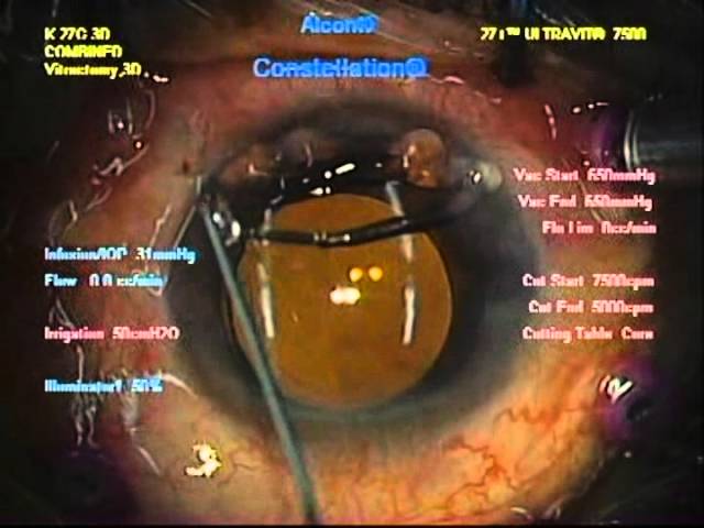 網膜剥離（裂孔原性網膜剥離）の硝子体手術　山王台病院付属眼科内科クリニック