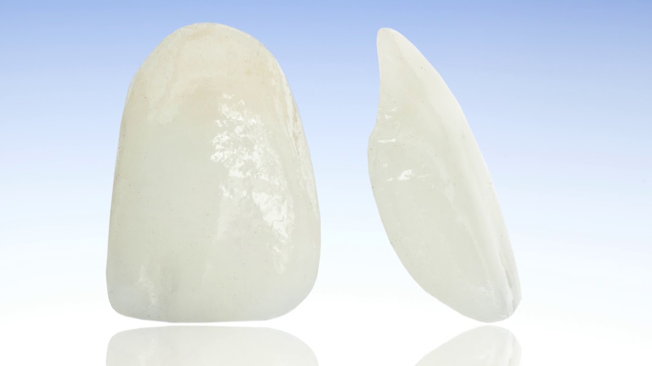 FAQ What are veneers? Washington Dental Associates YouTube
