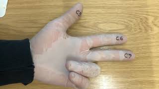 A Physical Mnemonic For Remembering The Root Values Of The Terminal Branches Of The Brachial Plexus