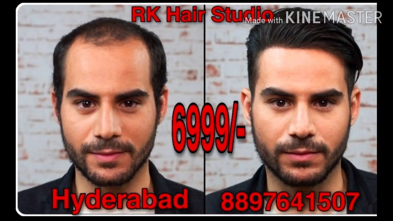 Low Cost Hair Transplant Solution