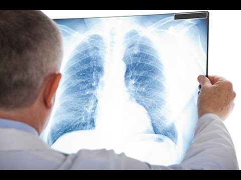 Vidéo: Une radiographie pulmonaire montrera-t-elle une embolie pulmonaire ?