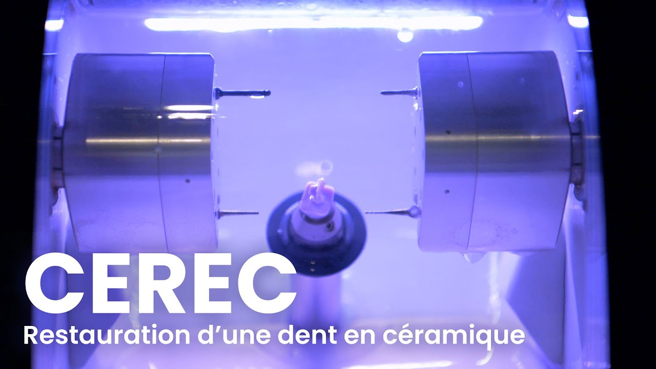 Restauration d'une dent en céramique (CEREC) - Centre Dentaire Caron