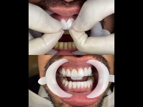 Lentes de Contato