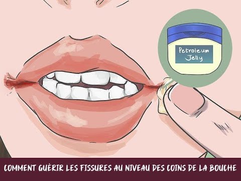 Vidéo: 3 façons de guérir une lèvre fendue