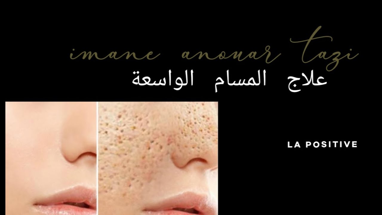 العلاج النهائي للمسام الواسعة | روتين العناية  ماركة the ordinary| بالبشرة الدهنية