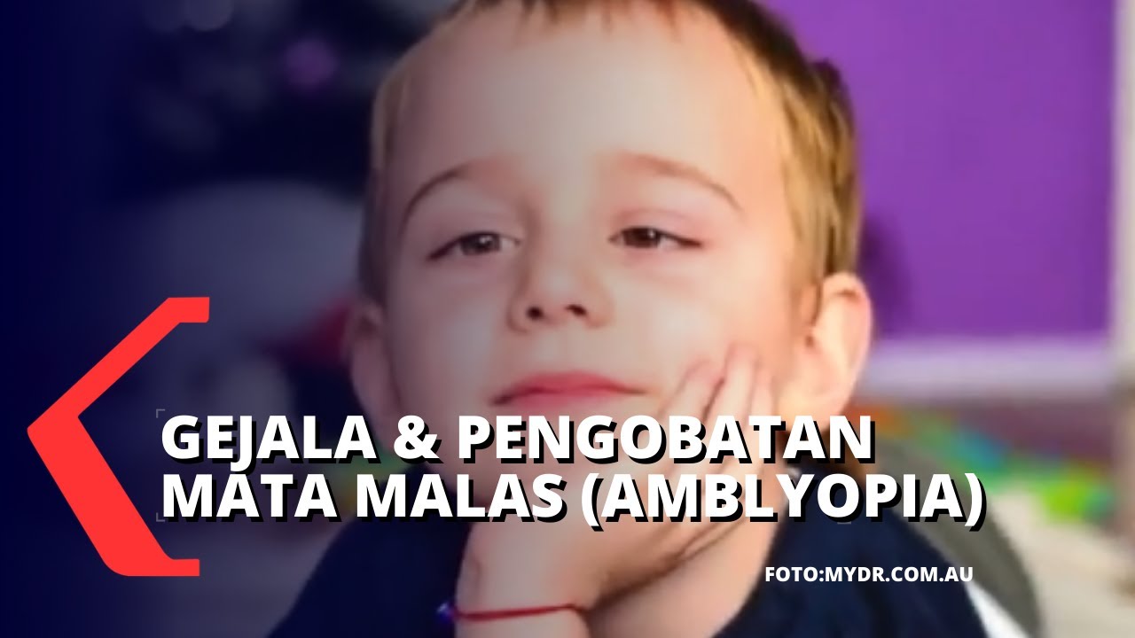 Deteksi Mata Malas atau Amblyopia dan Cara Pengobatannya