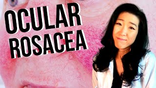 Ocular Rosacea | How Rosacea Can Affect Your Eyes!