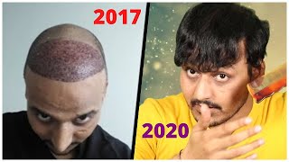 Hair Transplant in India 2020 | HAIR TRANSPLANT के बाद बालों की देखभाल कैसे करें | Best Tips
