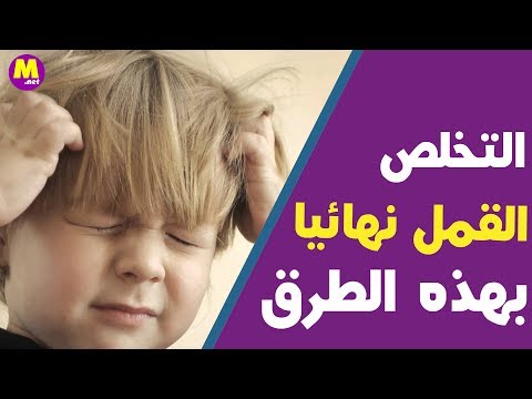 هل تعلم ما  هي أسباب ظهور القمل  في شعر الرأس عند الأطفال !؟التخلص من القمل والصيبان للأبد. 