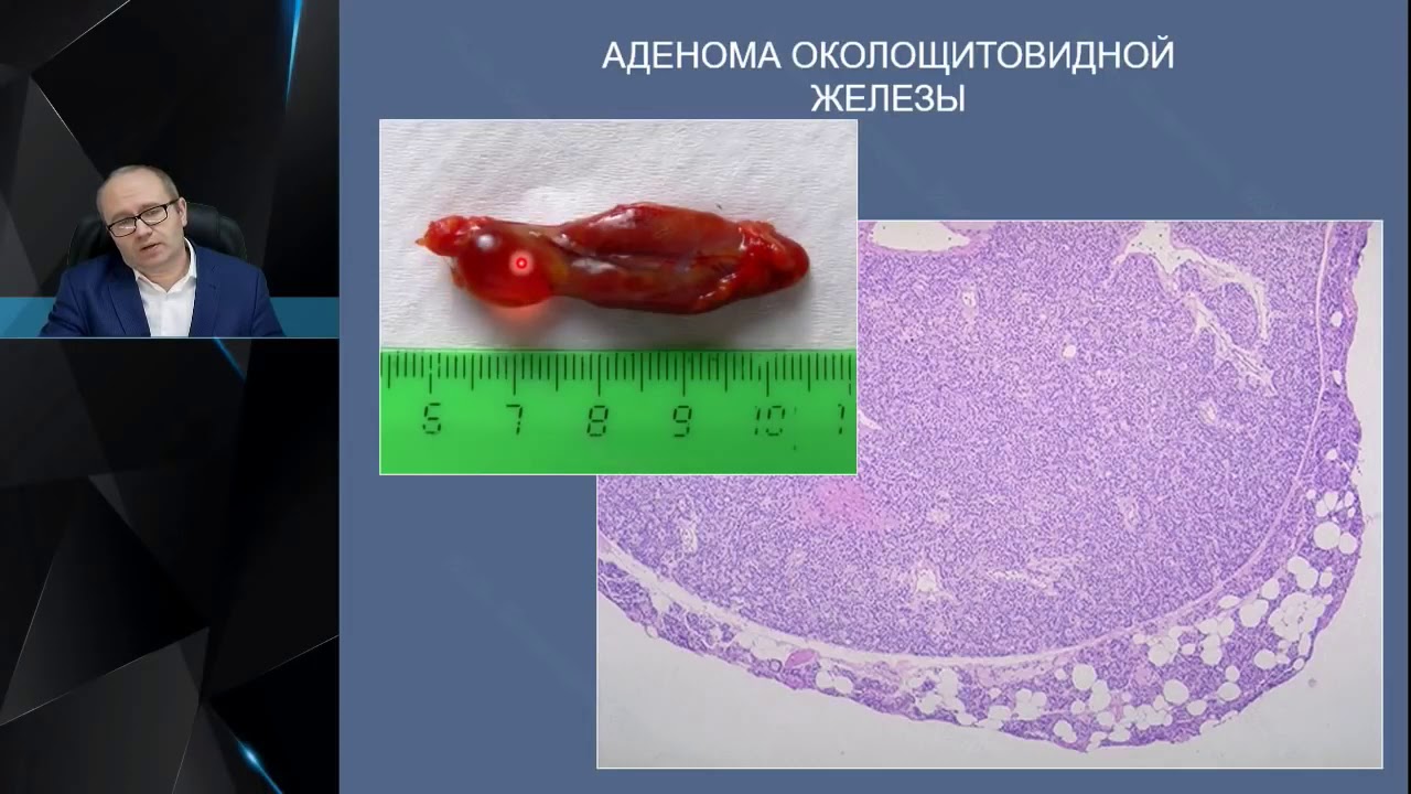 Профессор Слепцов И. В. :   Диагностика и лечение первичного гиперпаратиреоза