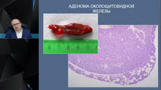 Профессор Слепцов И. В. :   Диагностика и лечение первичного гиперпаратиреоза