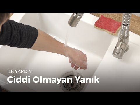 İlk yardım hareketlerini öğrenin: Ciddi olmayan yanık